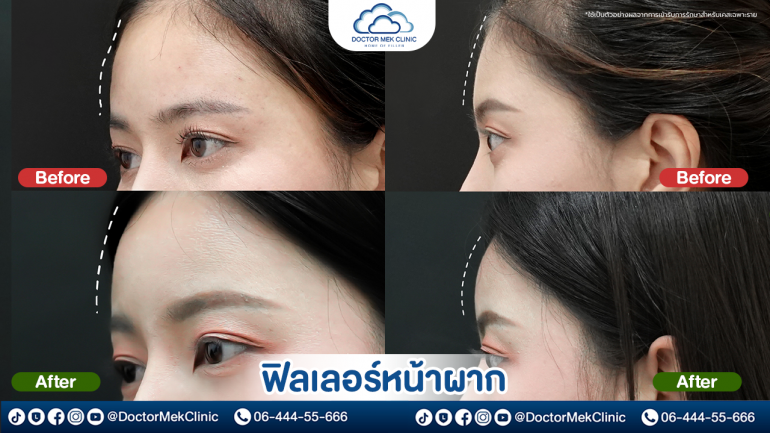 คิดถึงฟิลเลอร์ คิดถึง Doctor Mek Clinic คลินิกเสริมความงามชั้นนำของไทย โดดเด่นด้วยบริการฉีดฟิลเลอร์หน้าผาก โดยคุณหมอผู้ชำนาญการด้านฟิลเลอร์