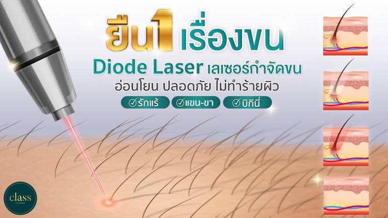 เลเซอร์กำจัดขนที่ดีที่สุดต้อง Diode Laser ที่ ‘Class Clinic’ คลินิกที่คนอีสานไว้ใจ พร้อมให้บริการ ปลอดภัย ไม่ทำร้ายผิว หมดปัญหาเรื่องของขน