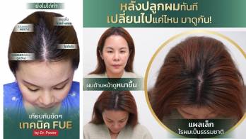 กลับมามั่นใจอีกครั้ง ด้วยเทคนิคการปลูกผม FUE แบบพิเศษ ที่ Meko Clinic ในราคาโปรโมชั่น !