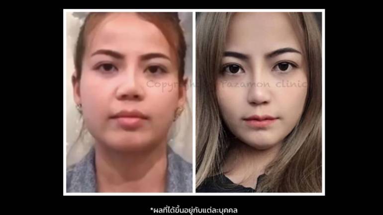 พัสมนคลินิก ผิวหนัง เลเซอร์ศัลยกรรม ครั้งที่5
